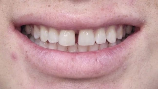 Sonrisa con un espacio visible entre los dos incisivos centrales superiores