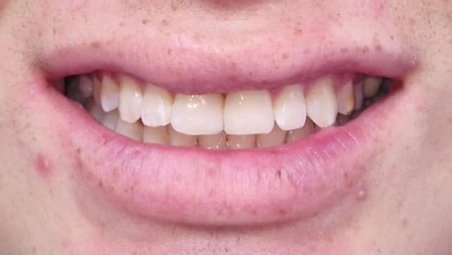 La misma sonrisa con el espacio entre los incisivos centrales cerrado con resina