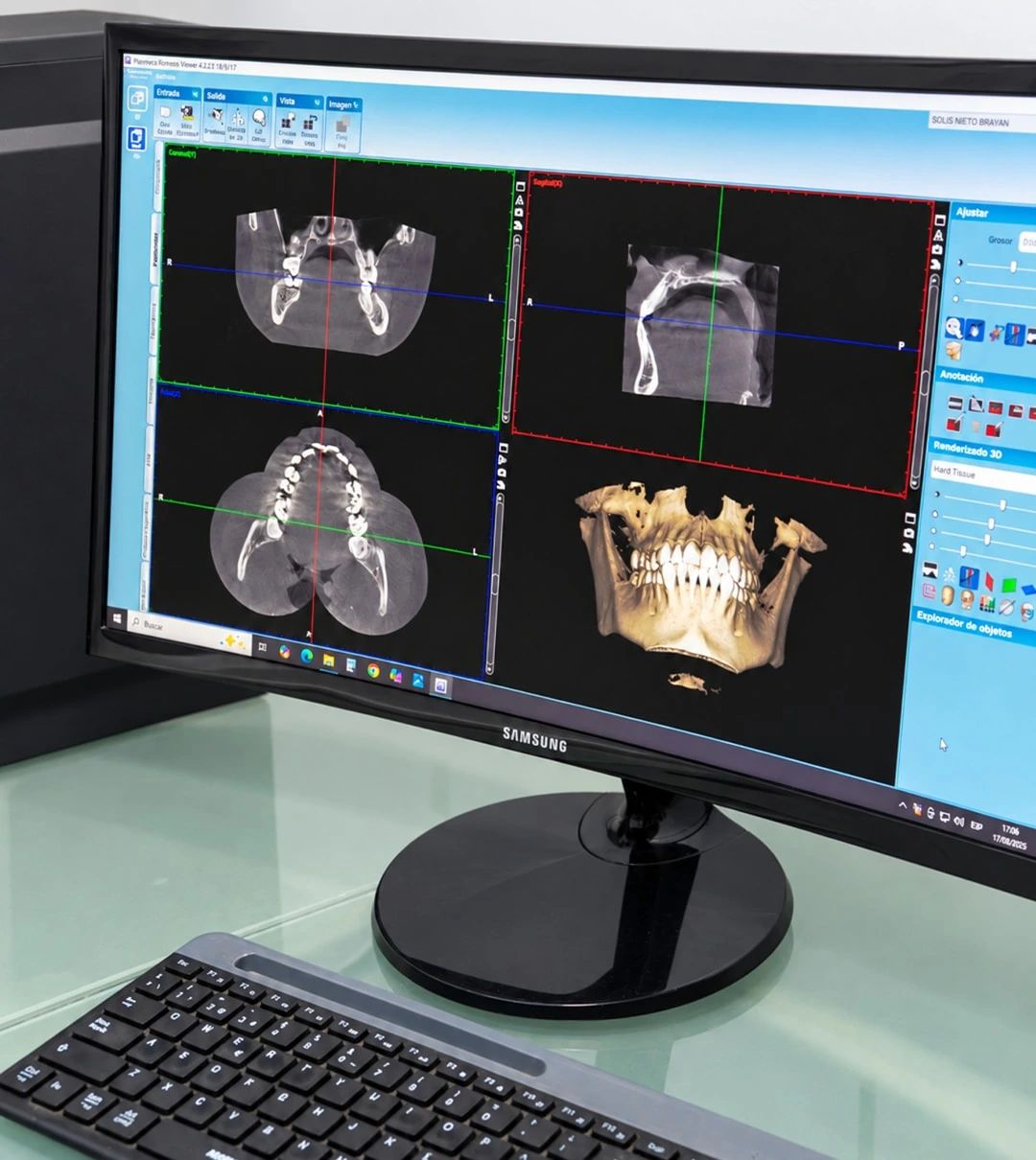 Un monitor muestra cortes de una tomografía dental y la reconstrucción en tres dimensiones del maxilar